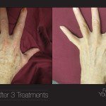 bbl hands before and after