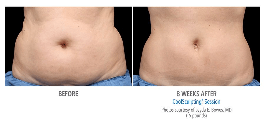 coolsculpting stomach before and after