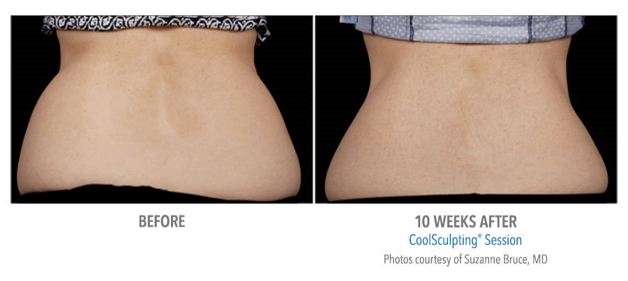 coolsculpting back before and after