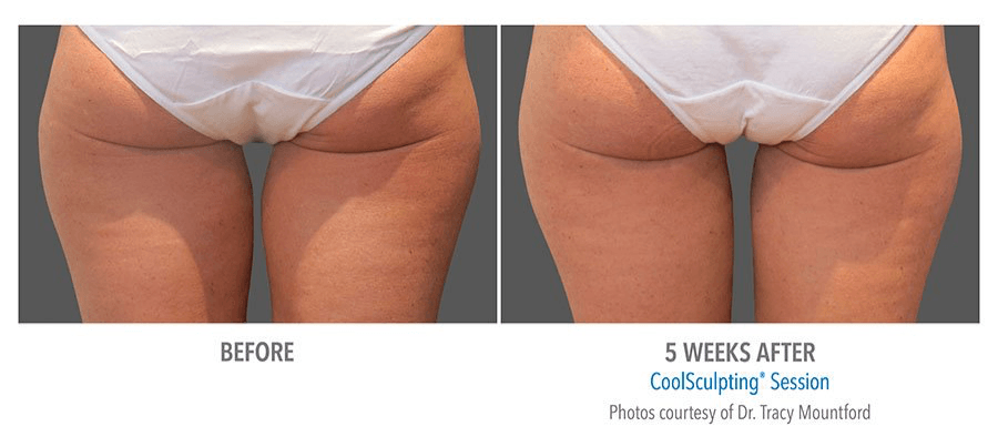 coolsculpting thighs before and after