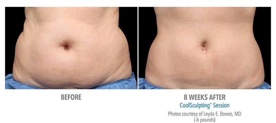 CoolSculpting® a Cool New You - The Cosmetic Surgery Clinic