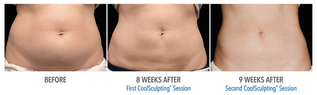 CoolSculpting Before and After London Ontario, Kitchener-Waterloo, The Cosmetic Surgery Clinic