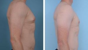 Gynecomastia Before and after - side view 