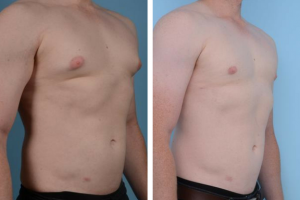 Gynecomastia Before and after - angle view