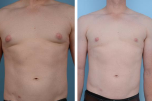 Gynecomastia Before and after -front view