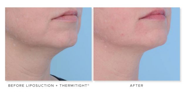 The Cosmetic Surgery Clinic, double chin treatment