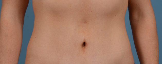 The Cosmetic Surgery Clinic, belly button