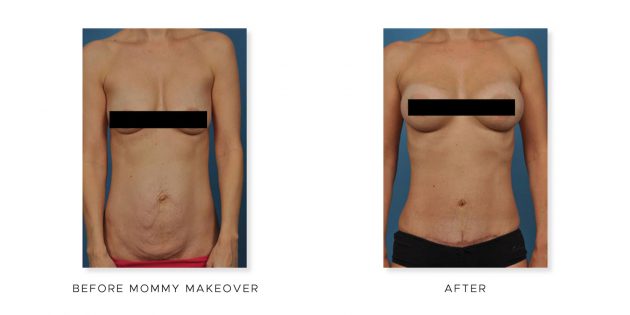 The Cosmetic Surgery Clinic, mommy makeover before and after