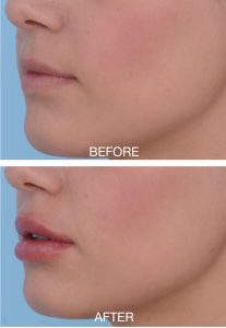 Before & After Injectables