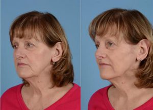 Before & After Facelift