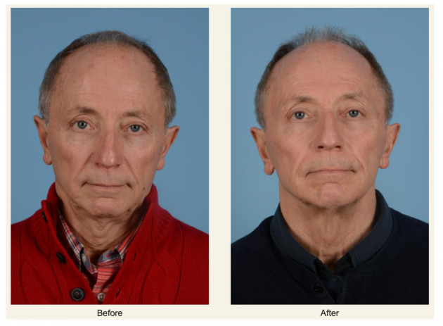 A Before and After side-by-side comparison of a man who has had BBL treatment