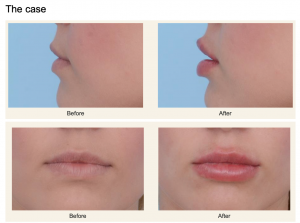 a woman's lips are shown from the side and the front. They are noticeably fuller and lifted in the "after" photos following treatment.