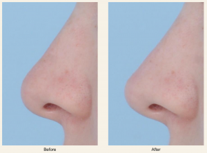 Another example of a successful liquid rhinoplasty with fillers