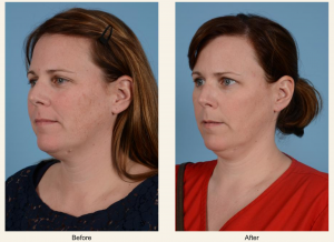 Before and After photos of a woman who was treated for hyperpigmentation.