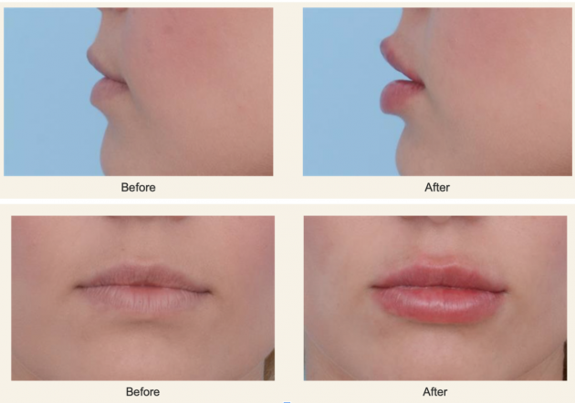 Before and after shots of lip fillers