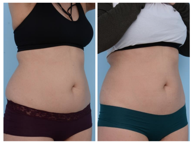 Before and after results of coolsculpting