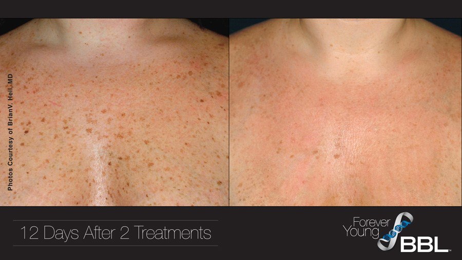Forever Young BBL before and after neck photos