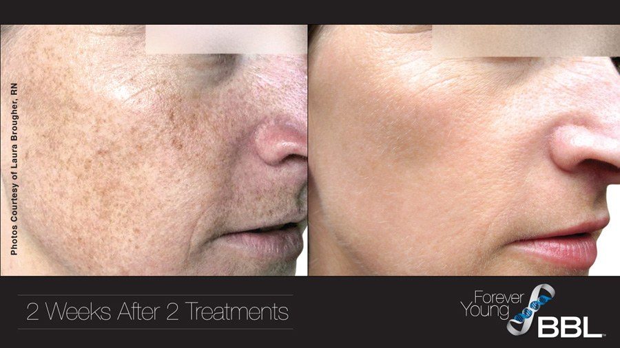 Forever Young BBL before and after facial photos