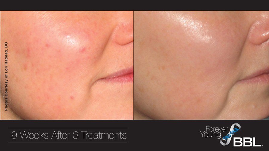Forever Young BBL before and after facial photos