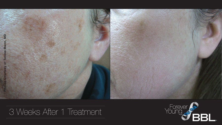 Forever Young BBL before and after facial photos