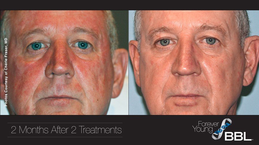 Forever Young BBL before and after facial photos