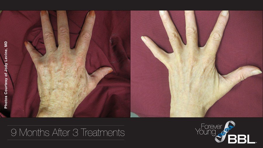 Forever Young BBL before and after hand photos
