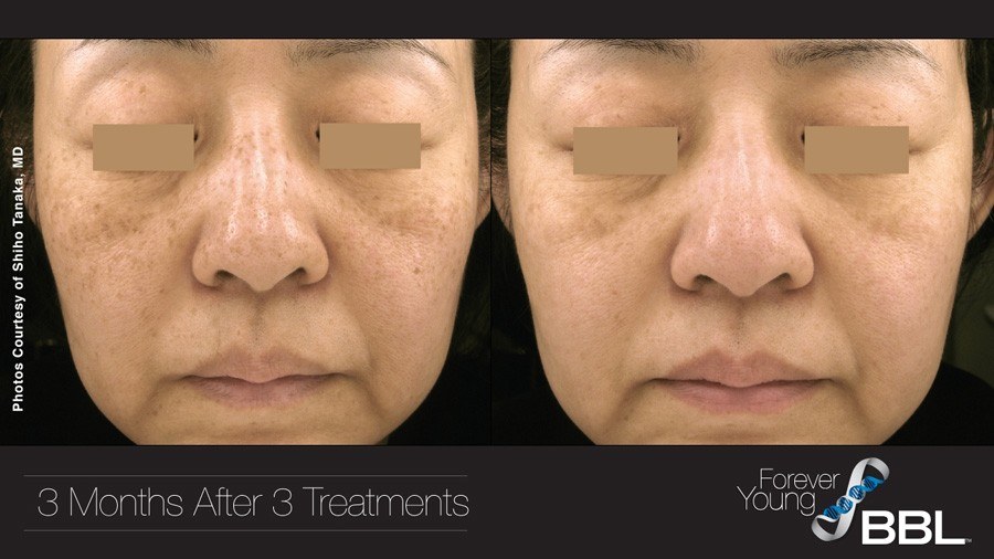 Forever Young BBL before and after facial photos