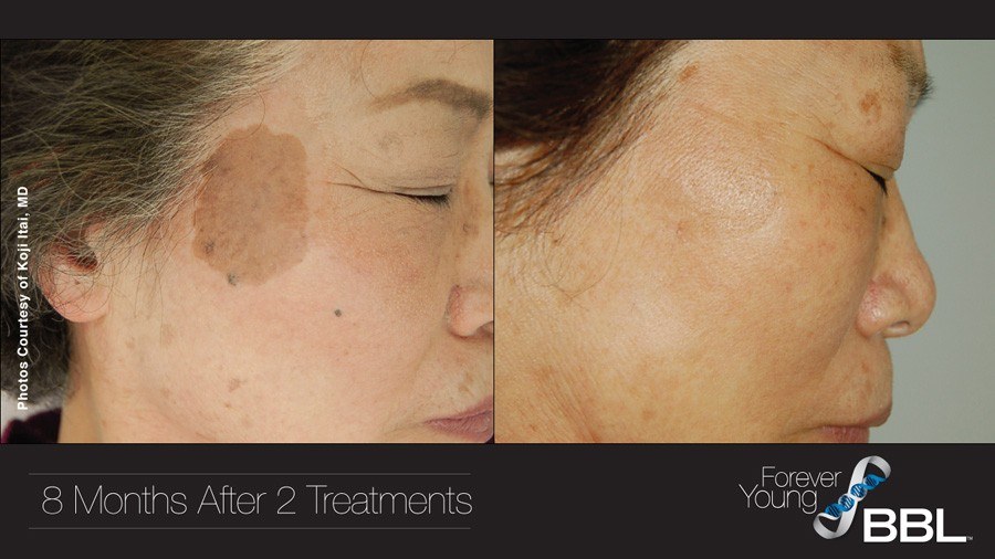 Forever Young BBL before and after facial photos