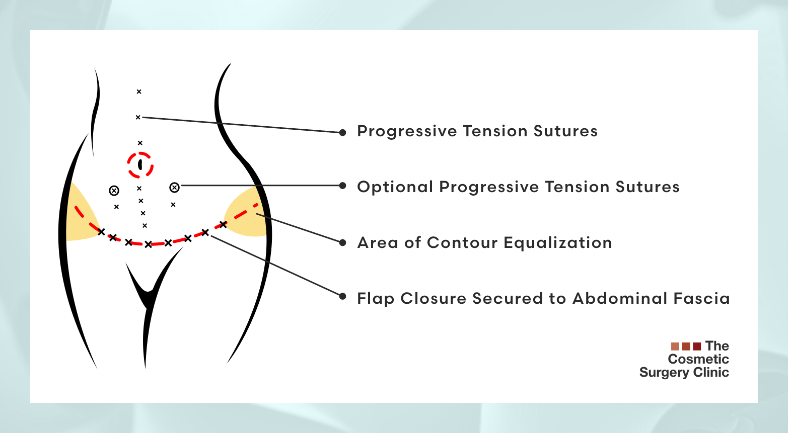 Infographic explaining how a drainless tummy tuck affects the healing process