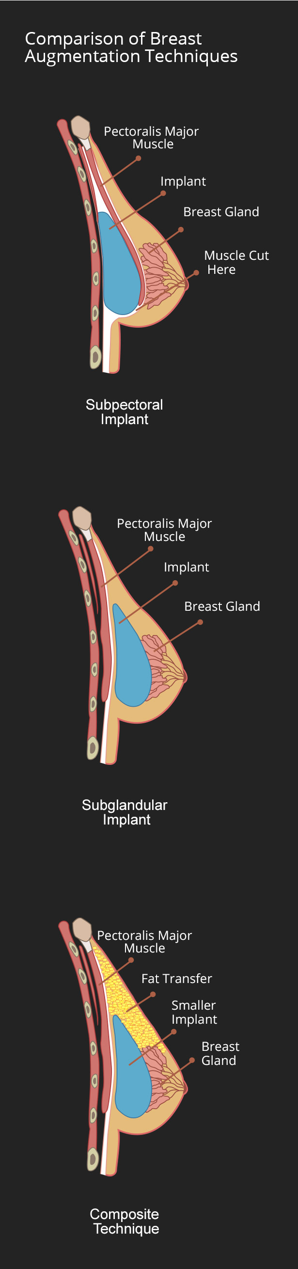 implant placement diagram