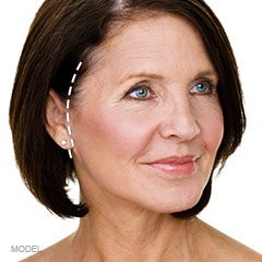 Facelift Incision Location