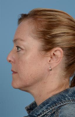 Facial Rejuvenation  and Skincare  case #110