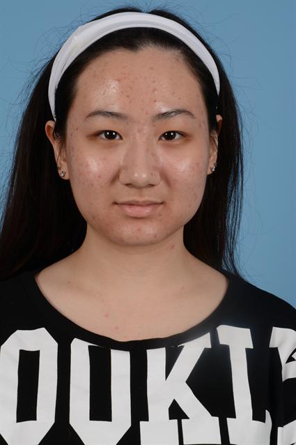 acne female before