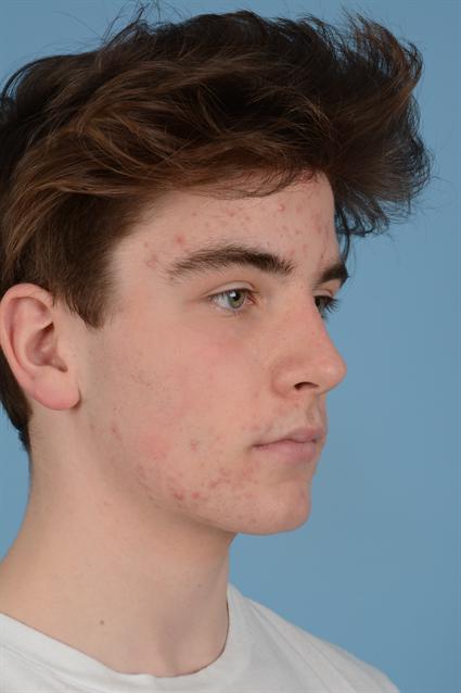 young man facial acne before