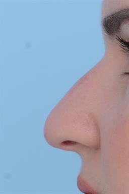 Non-Surgical Rhinoplasty (nose shaping) case #193