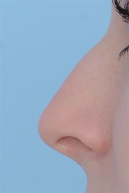 Non-Surgical Rhinoplasty (nose shaping) case #194