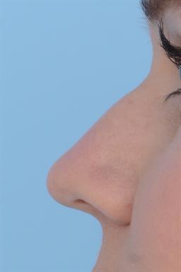 Non-Surgical Rhinoplasty (nose shaping) case #197