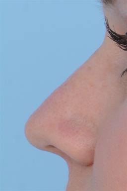 Non-Surgical Rhinoplasty (nose shaping) case #197