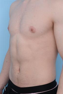 Male Breast Reduction / Gynecomastia case #204