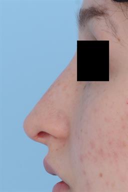 Non-Surgical Rhinoplasty (nose shaping) case #214