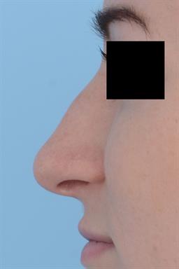 Non-Surgical Rhinoplasty (nose shaping) case #215