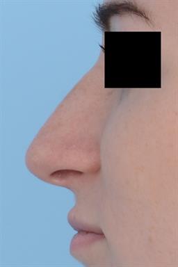 Non-Surgical Rhinoplasty (nose shaping) case #215