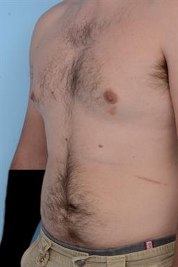Male Breast Reduction / Gynecomastia case #226