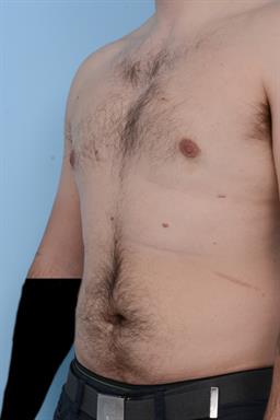 Male Breast Reduction / Gynecomastia case #226