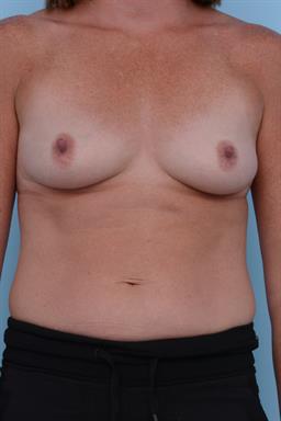 Breast Augmentation case #227