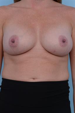 Breast Augmentation case #227