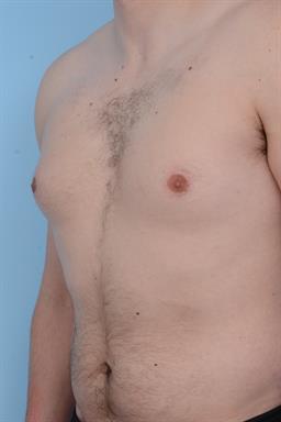 Male Breast Reduction / Gynecomastia case #240