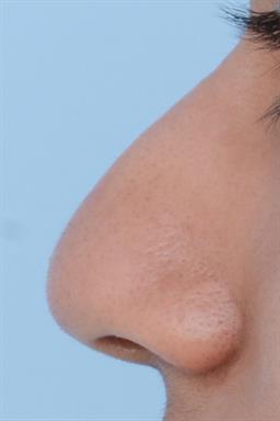 Non-Surgical Rhinoplasty (nose shaping) case #278