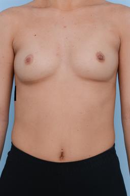 Breast Augmentation case #286