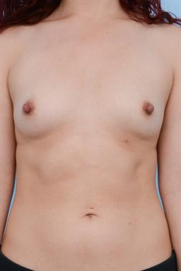 Breast Augmentation case #289